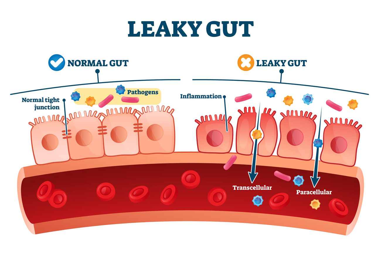 What Is Leaky Gut?